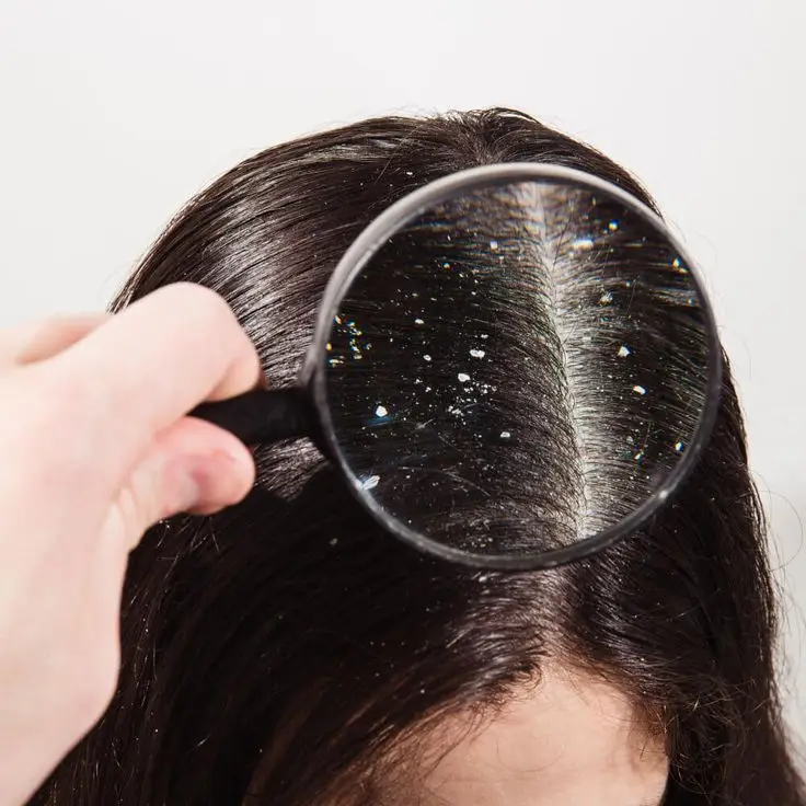 Effective Solutions for Dandruff Effective Solutions for Dandruff Dandruff is a common scalp issue affecting many people. White flakes and itchiness can cause both aesthetic and comfort concerns. However, with the right products and habits, you can effectively manage dandruff. Here are professional solutions and product recommendations for dealing with dandruff. dandruff Effective Solutions for Dandruff